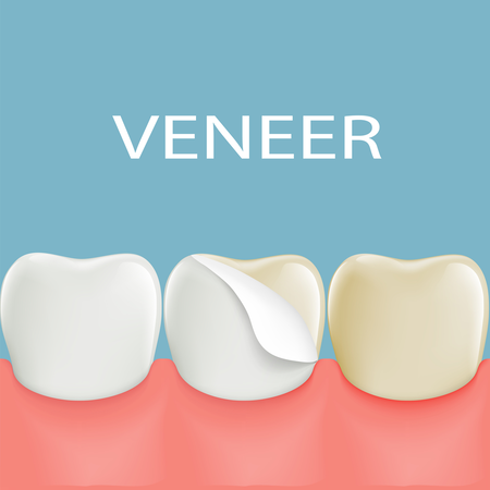 DÁN MẶT RĂNG SỨ, DÁN MẶT RĂNG SỨ VENEER